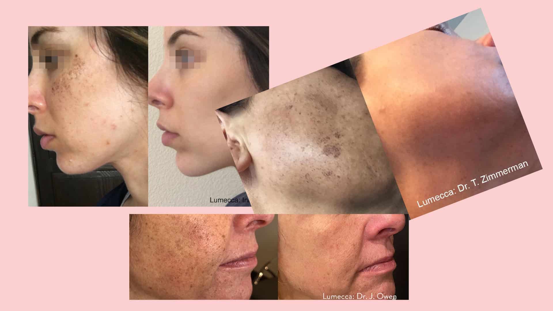 Luxe Bible Reviews Lumecca IPL at the Dr David Jack Clinic: Typical results after 3-6 treatments