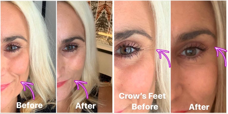 before and after botox and filler at SAS Aesthetics