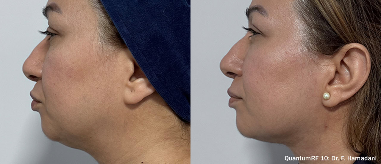 Want a sharper jawline? It can help define and lift.