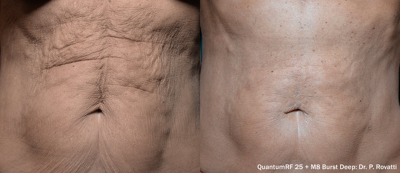 The benefits of QuantumRF are plain to see